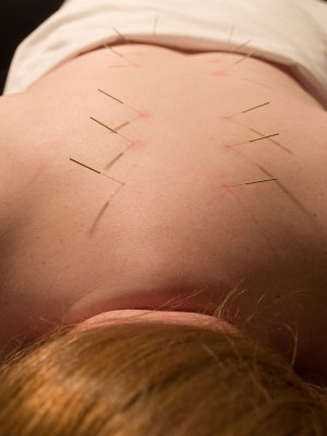Acupuncture session