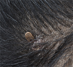 Tick embedded in scalp